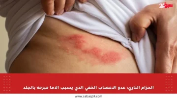الحزام الناري: عدو الأعصاب الخفي الذي يسبب آلاما مبرحة بالجلد